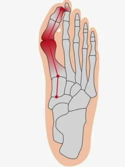 Coussinet pour hallux confortable à porter